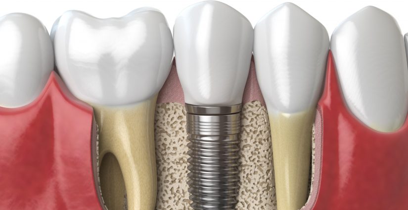 Dental Implants